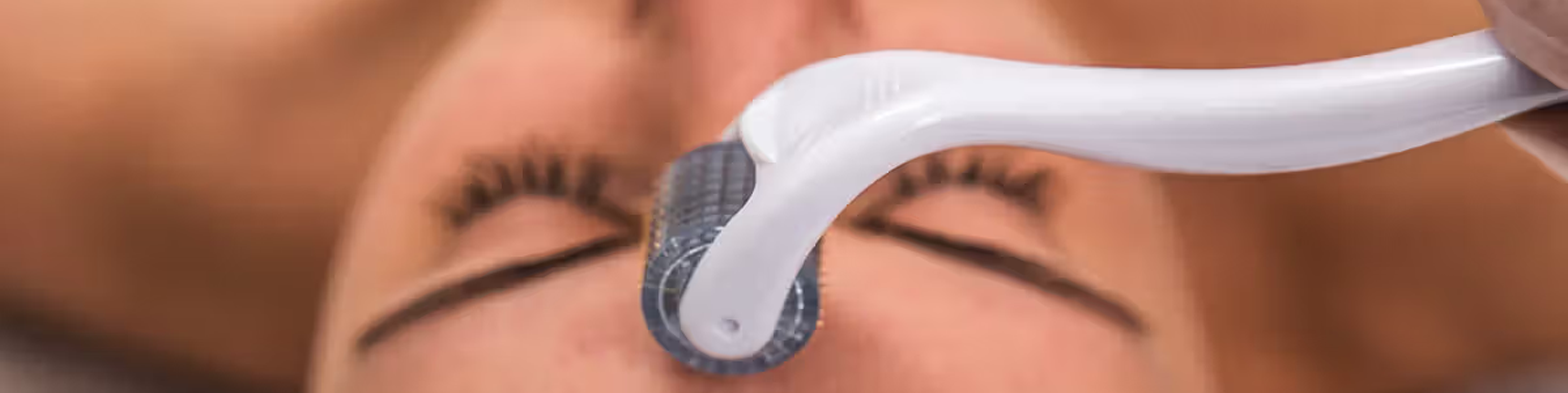 Microneedling Treatment